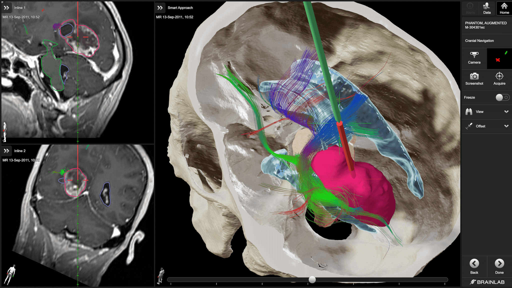 Cranial Navigation: Advanced Neuronavigation